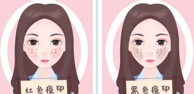臉上紅色痘印幾個(gè)月都不消怎么辦？紅色痘印應(yīng)該怎么消除？