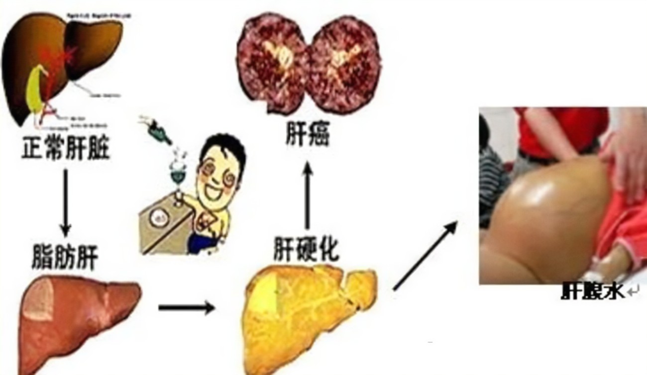 查出肝硬化還有救嗎？