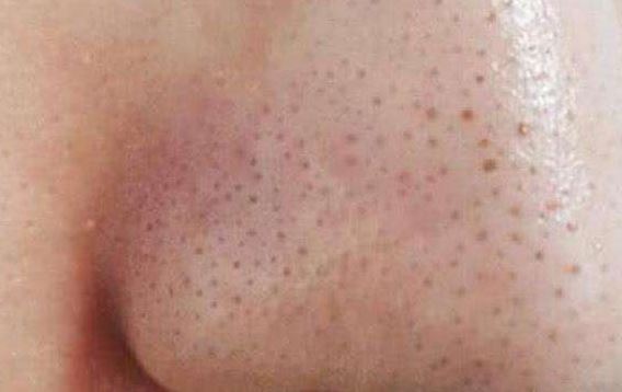 清潔面膜哪個牌子可以快速祛黑頭？趙薇、薇婭 推薦的紐西之謎泥膜真的好用嗎？